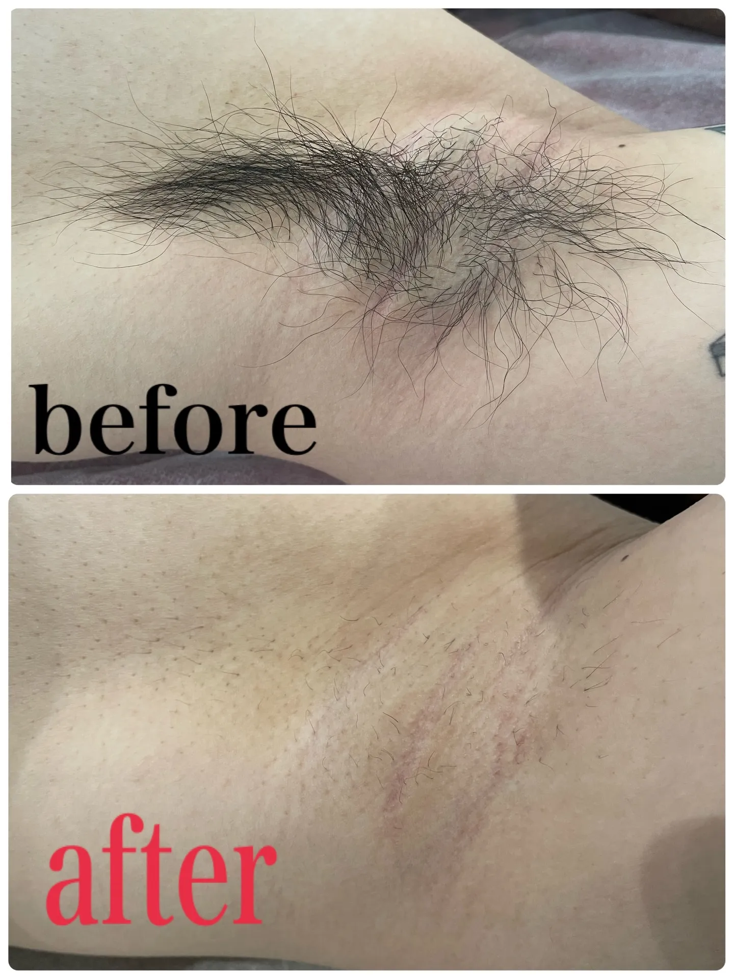 【蒲田でワキ脱毛✨臭いケア&清潔感アップ】